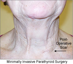 minimally invasive parathyroid surgery